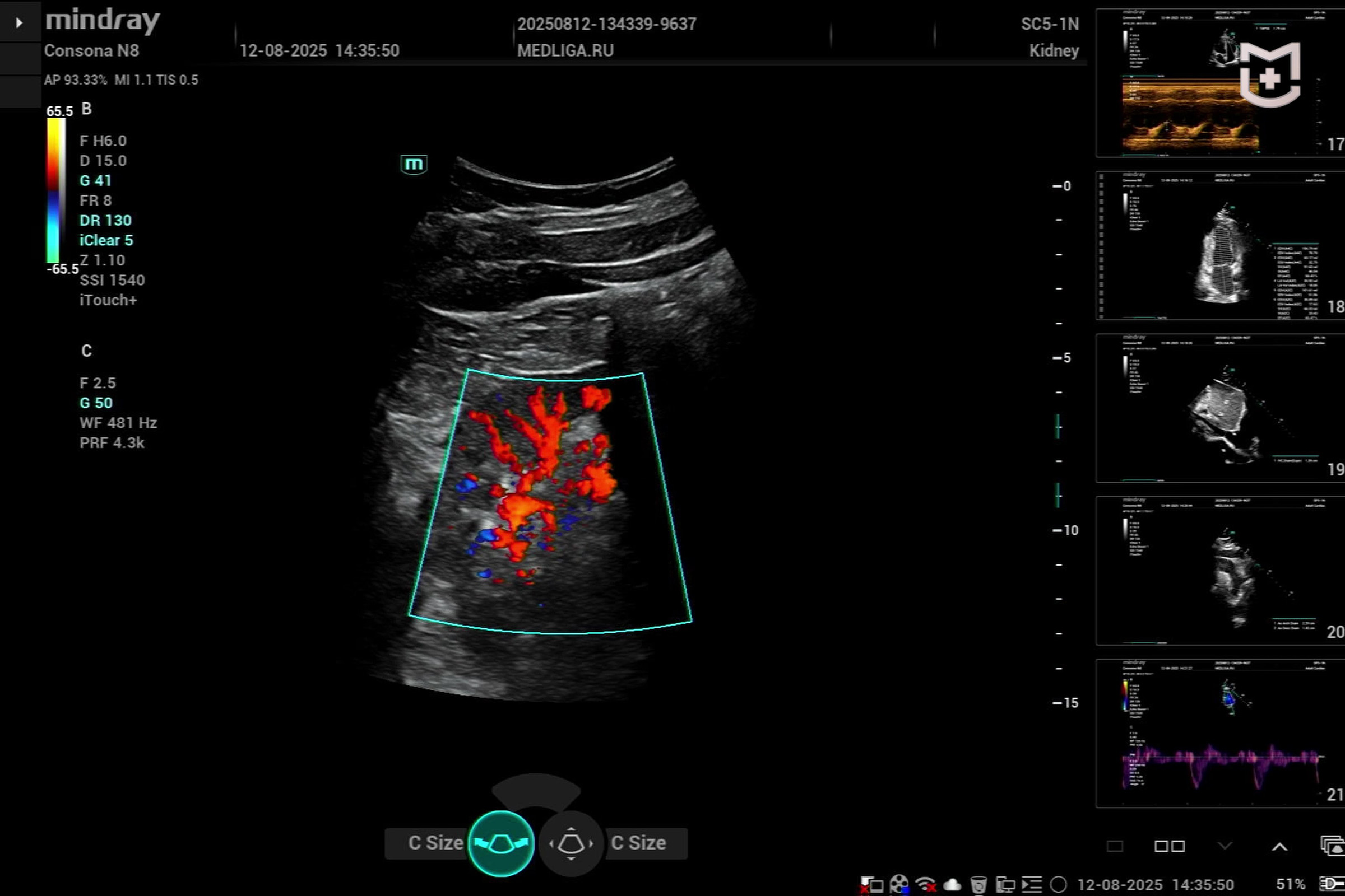 УЗИ брюшной полости и почек: Mindray Consona N8 в реальной работе
